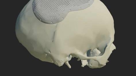 3D-модель черепа при кринопластике